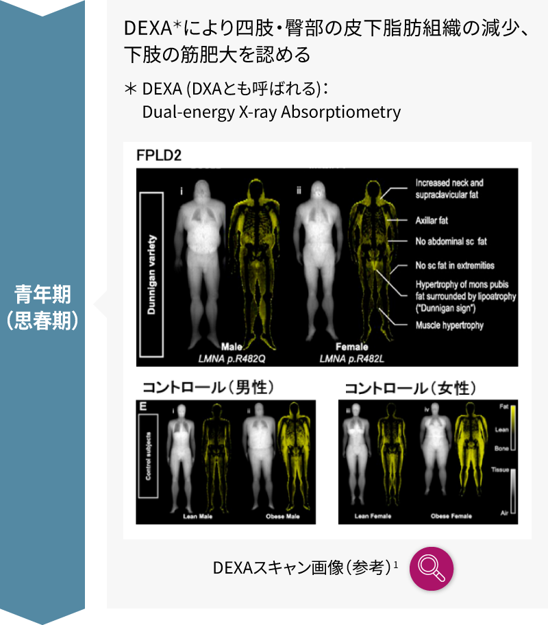 クッシング症候群が疑われた女性患者